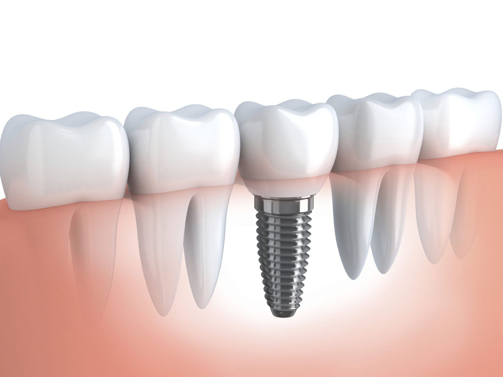Implantes Dentários
